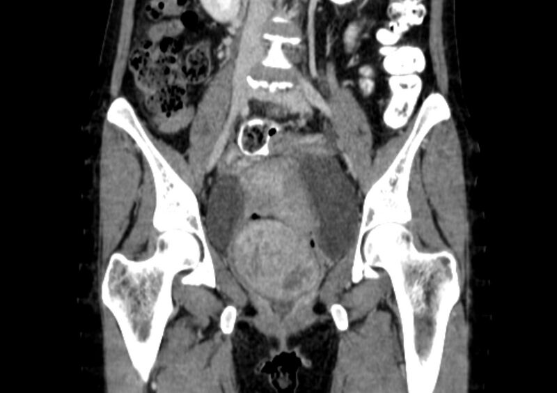 File:Non-puerperal uterine inversion (Radiopaedia 78343-91094 B 1).jpg