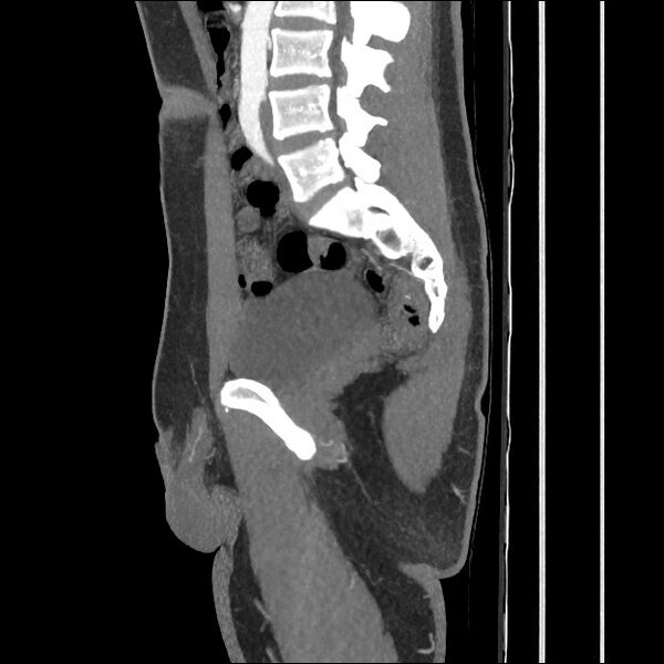 File:Normal CT angiogram of pelvis (Radiopaedia 45390-49430 C 33).jpg