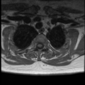 Normal cervical and thoracic spine MRI (Radiopaedia 35630-37156 Axial T1 2).png