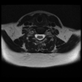 Normal cervical and thoracic spine MRI (Radiopaedia 35630-37156 Axial T2 13).png