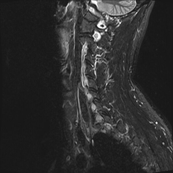 File:Normal cervical spine MRI (Radiopaedia 38418-40496 Sagittal STIR 2).jpg