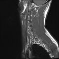 Normal cervical spine MRI (Radiopaedia 38418-40496 Sagittal T1 1).jpg