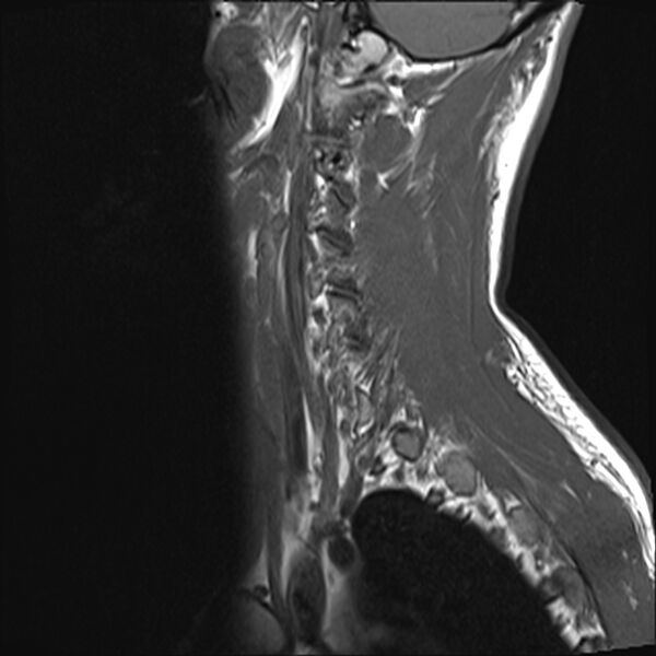 File:Normal cervical spine MRI (Radiopaedia 38418-40496 Sagittal T1 1).jpg