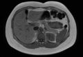 Normal liver MRI with Gadolinium (Radiopaedia 58913-66163 Axial T1 in-phase 20).jpg
