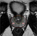 Normal prostate (MRI) (Radiopaedia 29986-30536 D 1).png
