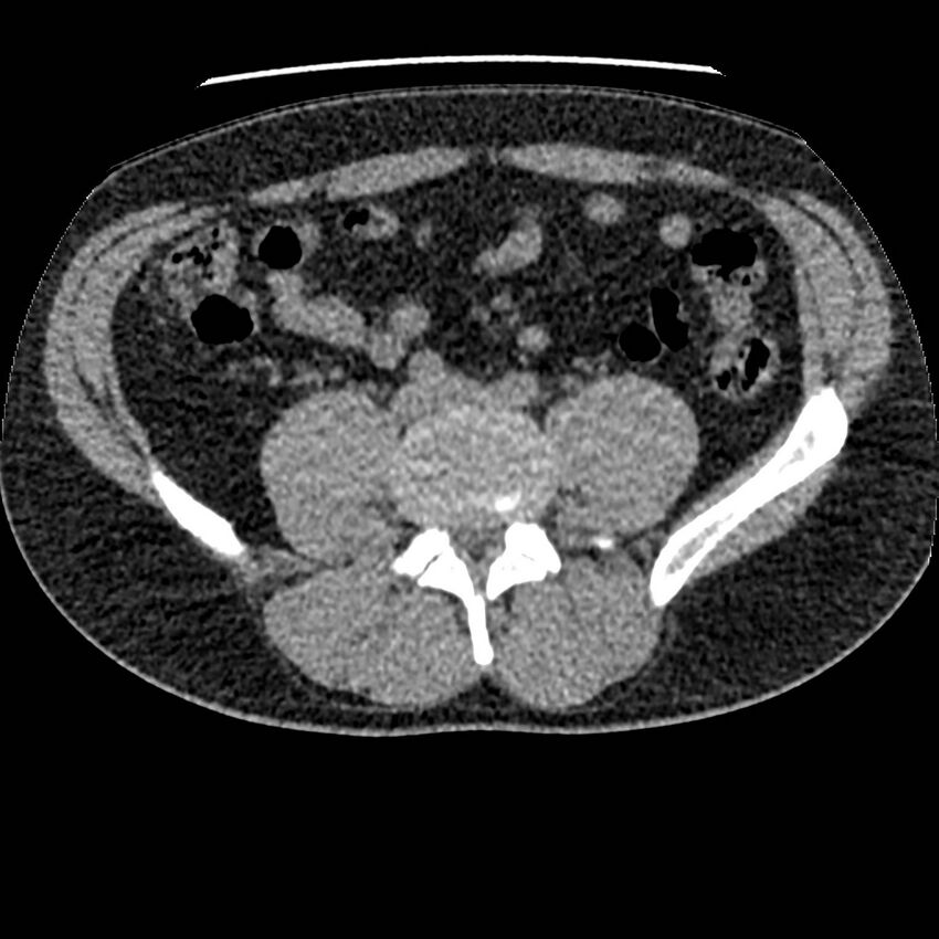 Obstructing ureteric calculus and ureteric anatomy (Radiopaedia 62730-71042 Axial non-contrast 93).jpg