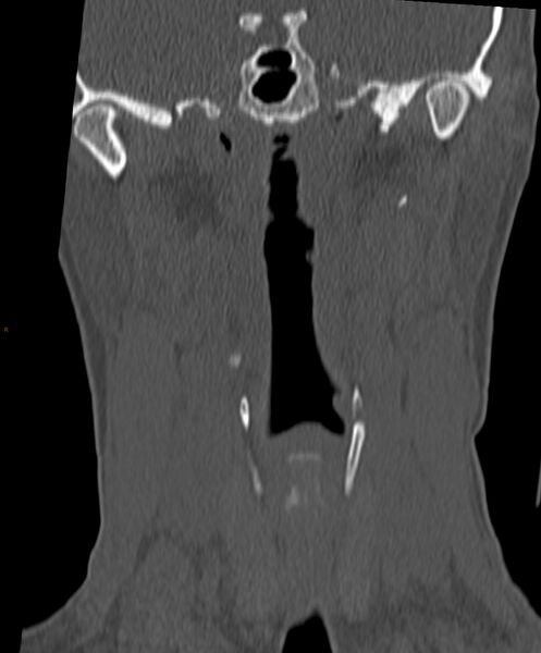 File:Occipital condyle fracture (Radiopaedia 61165-69056 Coronal bone window 14).jpg