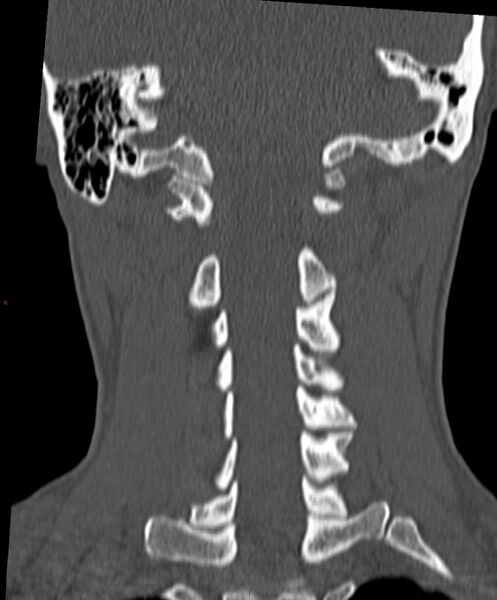 File:Occipital condyle fracture (Radiopaedia 61165-69056 Coronal bone window 5).jpg