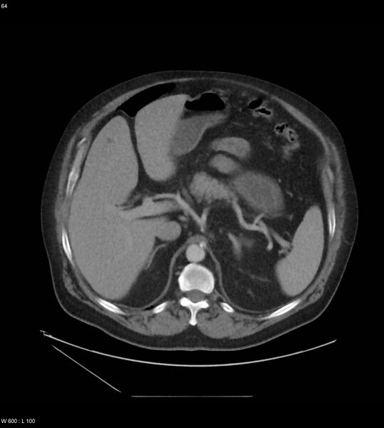 File:Abdominal aortic aneurysm with intramural hematoma then rupture (Radiopaedia 50278-55631 Axial C+ arterial phase 55).jpg