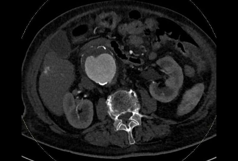 File:Abdominal aortic aneurysm with thrombus fissuration (Radiopaedia 73192-83919 Axial C+ arterial phase 72).jpg