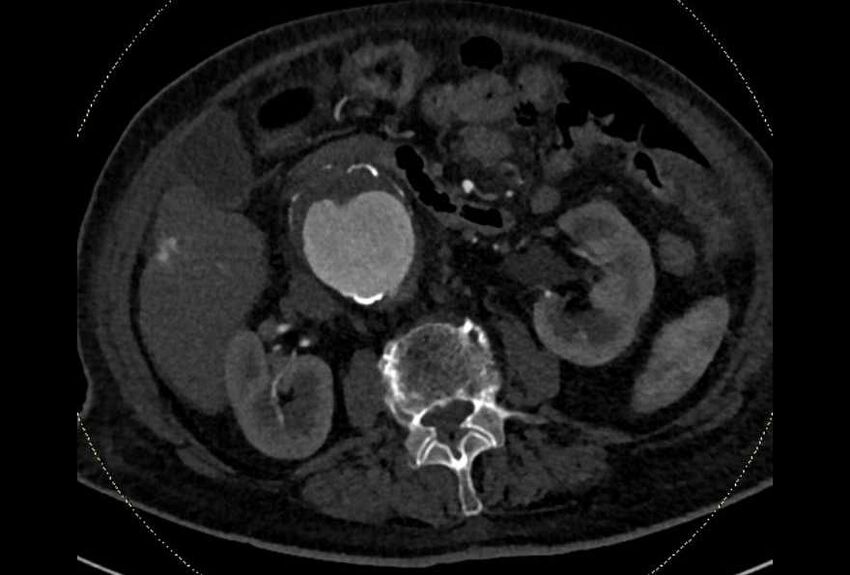 Abdominal aortic aneurysm with thrombus fissuration (Radiopaedia 73192-83919 Axial C+ arterial phase 72).jpg