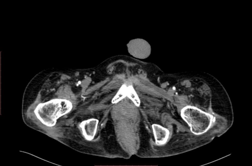 Abdominal aortic interposition tube graft and aneurysm thrombosis (Radiopaedia 71438-81857 Axial C+ arterial phase 259).jpg