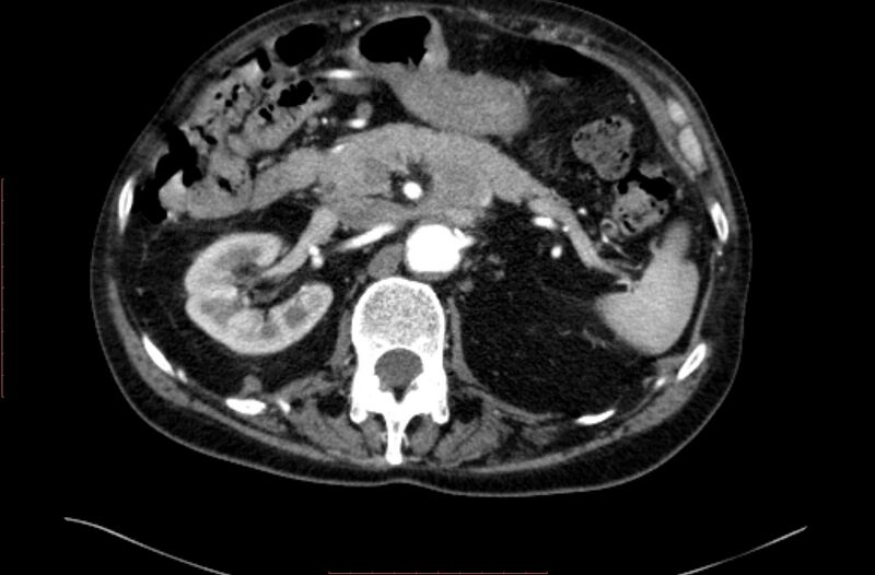 File:Abdominal aortic interposition tube graft and aneurysm thrombosis (Radiopaedia 71438-81857 Axial C+ arterial phase 35).jpg