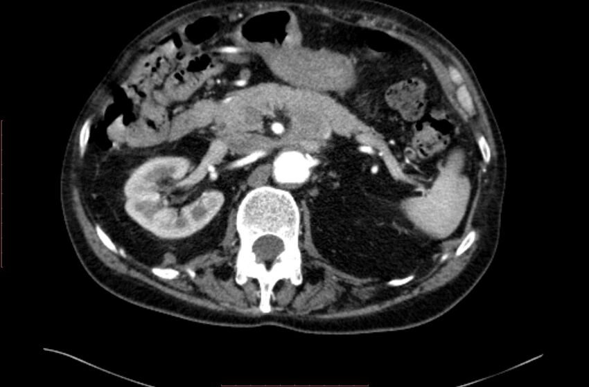 Abdominal aortic interposition tube graft and aneurysm thrombosis (Radiopaedia 71438-81857 Axial C+ arterial phase 35).jpg