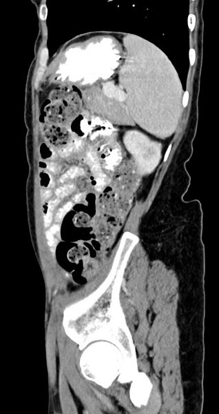 File:Abdominal wall and retroperitoneal tuberculosis (Radiopaedia 88137-104729 Sagittal C+ portal venous phase 37).jpg