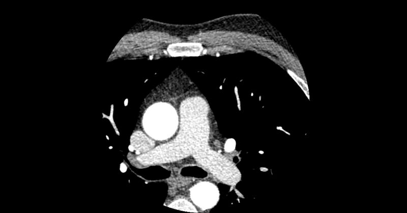 File:Aberrant left main coronary artery (ALMCA) arising from the right sinus with interarterial course (Radiopaedia 63251-71814 Axial C+ arterial phase 19).JPG