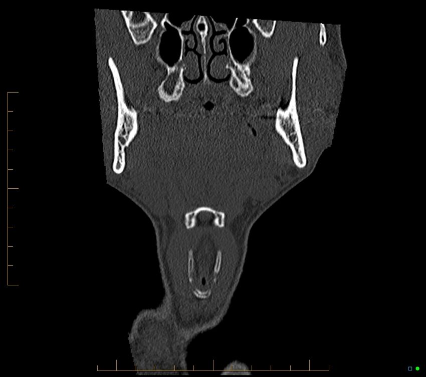 Accessory articulation of cervical transverse processes (Radiopaedia 82715-96933 Coronal non-contrast 12).jpg