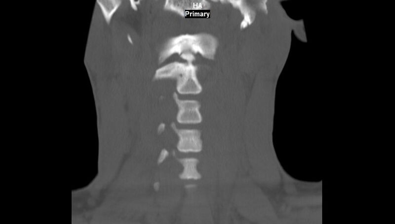 File:Accessory ossicle of the anterior arch of C1 vertebra (Radiopaedia 58149-65211 Coronal bone window 3).jpg