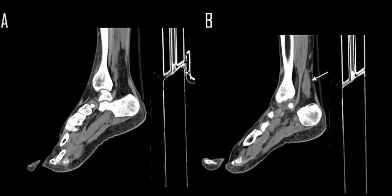 File:Accessory soleus muscle (Radiopaedia 61069-68944 A 1).jpg