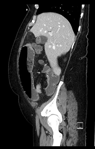 File:Active Crohn disease (Radiopaedia 59394-66750 Sagittal C+ portal venous phase 44).jpg