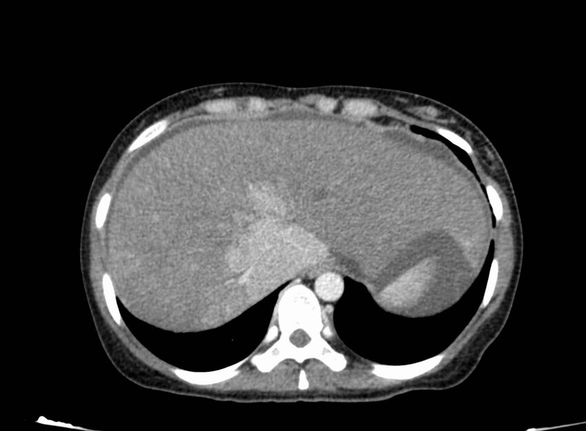 Acute Budd-Chiari syndrome (Radiopaedia 60858-68638 Axial C+ portal venous phase 41).jpg