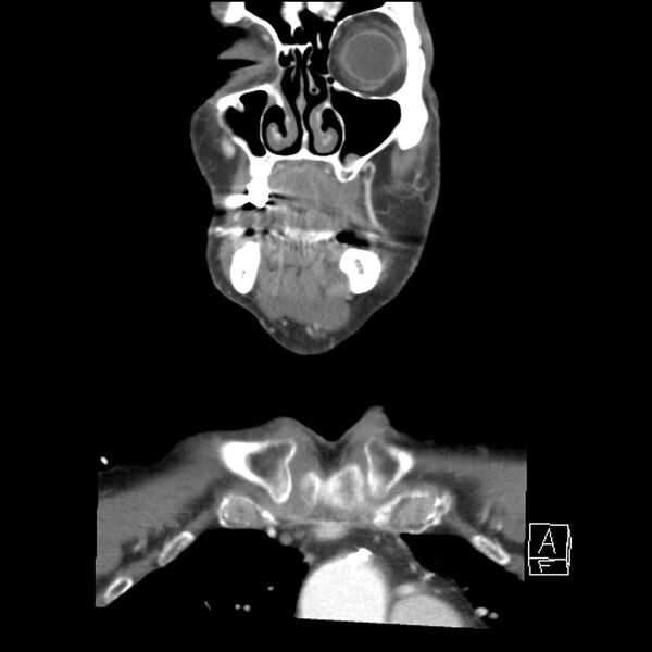 File:Acute ICA ischemic penumbra due to high-grade CCA stenosis (CT perfusion) (Radiopaedia 72038-82530 Coronal C+ arterial phase 1).jpg