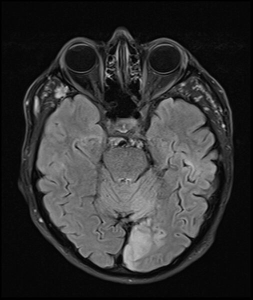 File:Acute P1 occlusion with PCA ischemia penumbra (CT perfusion) (Radiopaedia 72084-82590 Axial FLAIR 12).jpg
