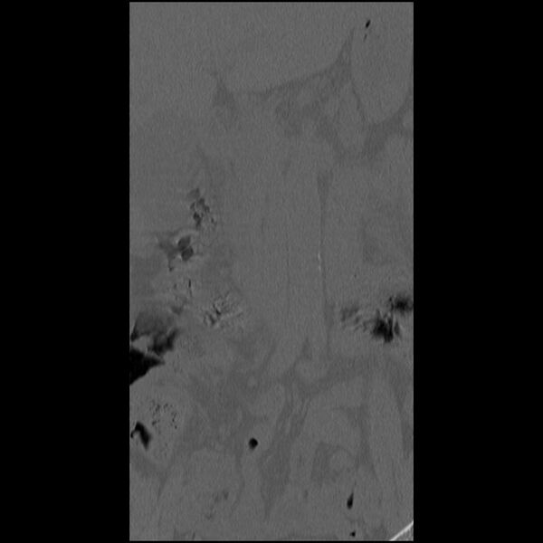 File:Acute Schmorl's node (Radiopaedia 83276-102365 Coronal bone window 6).jpg