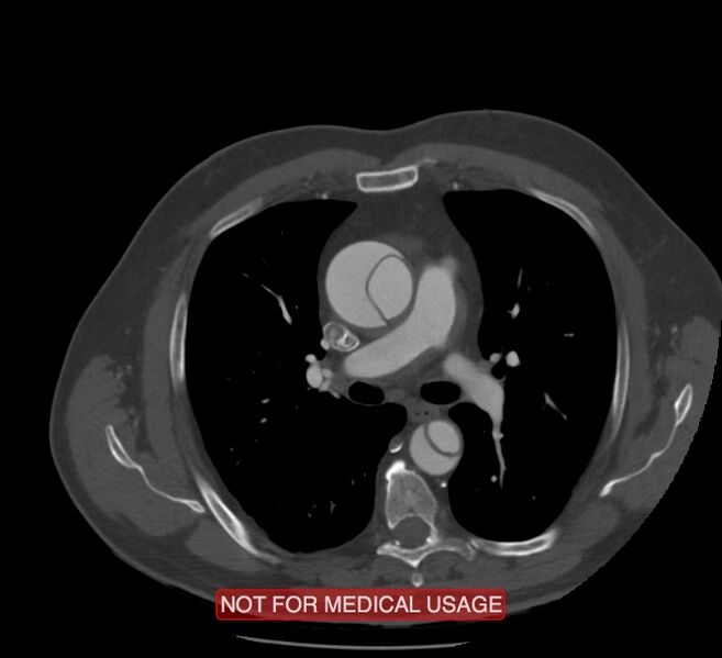 File:Acute aortic dissection - Stanford type A (Radiopaedia 40661-43285 Axial C+ arterial phase 23).jpg