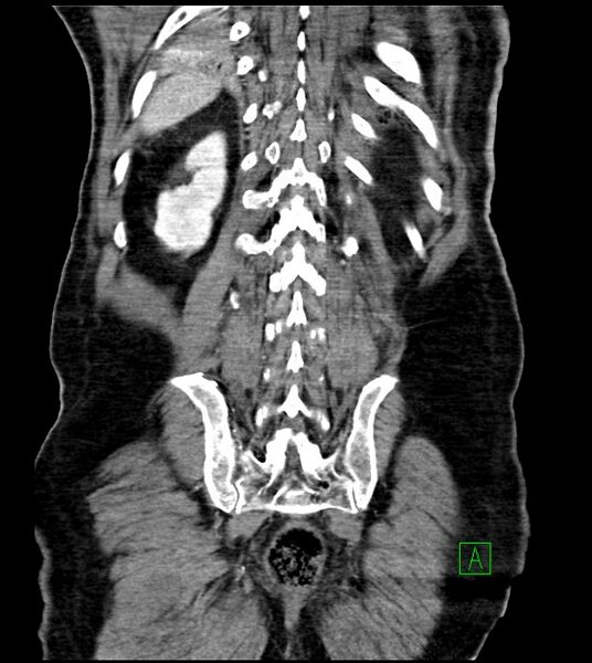 File:Acute arterial mesenteric ischemia (Radiopaedia 78238-90828 Coronal C+ portal venous phase 75).jpg