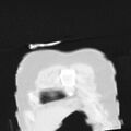 Acute aspiration pneumonitis (Radiopaedia 33605-34703 Coronal lung window 9).jpg