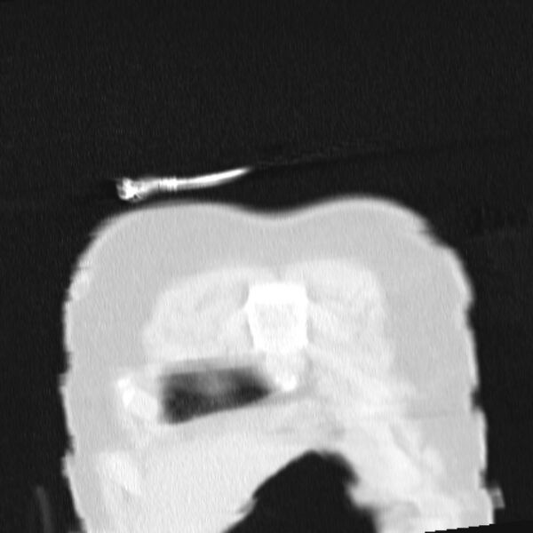 File:Acute aspiration pneumonitis (Radiopaedia 33605-34703 Coronal lung window 9).jpg
