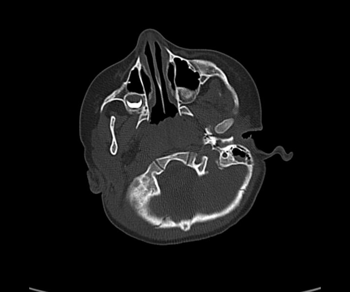 File:Acute hemorrhagic contusion (Radiopaedia 63660-72336 Axial bone window 11).jpg