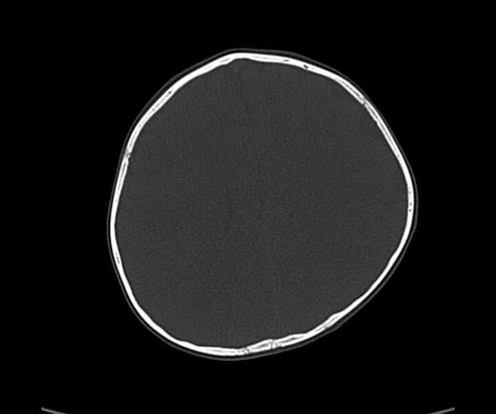 File:Acute hemorrhagic contusion (Radiopaedia 63660-72336 Axial bone window 45).jpg