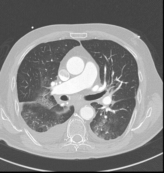 File:Acute myocardial infarction (Radiopaedia 23413-23481 lung window 22).jpg