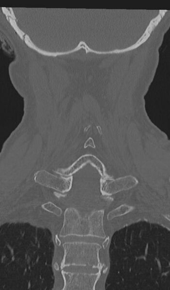 File:Acute on chronic subdural hematoma and thoracic vertebral injury in a multitrauma patient (Radiopaedia 31698-32619 Coronal bone window 48).jpg