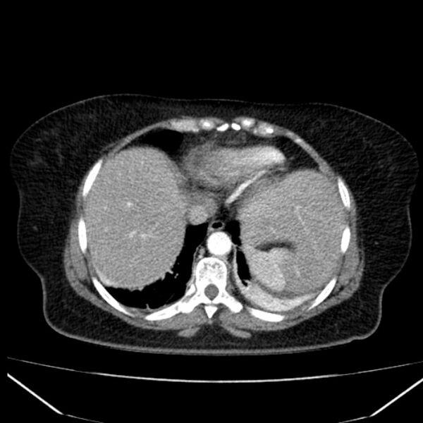 File:Acute pancreatitis - Balthazar C (Radiopaedia 26569-26714 Axial C+ arterial phase 10).jpg