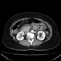 Acute pancreatitis - Balthazar C (Radiopaedia 26569-26714 Axial C+ arterial phase 39).jpg