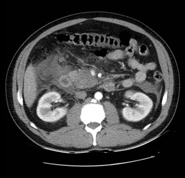 File:Acute pancreatitis - Balthazar E (Radiopaedia 23080-23110 Axial C+ arterial phase 30).jpg