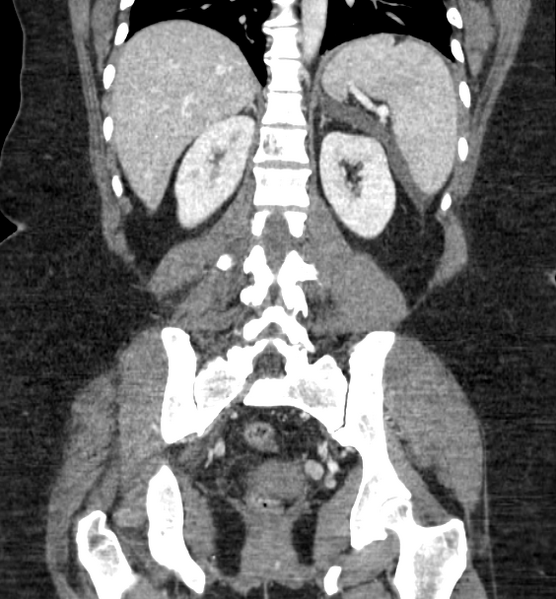 File:Acute pancreatitis - Balthazar E (Radiopaedia 29016-29377 Coronal C+ portal venous phase 65).png