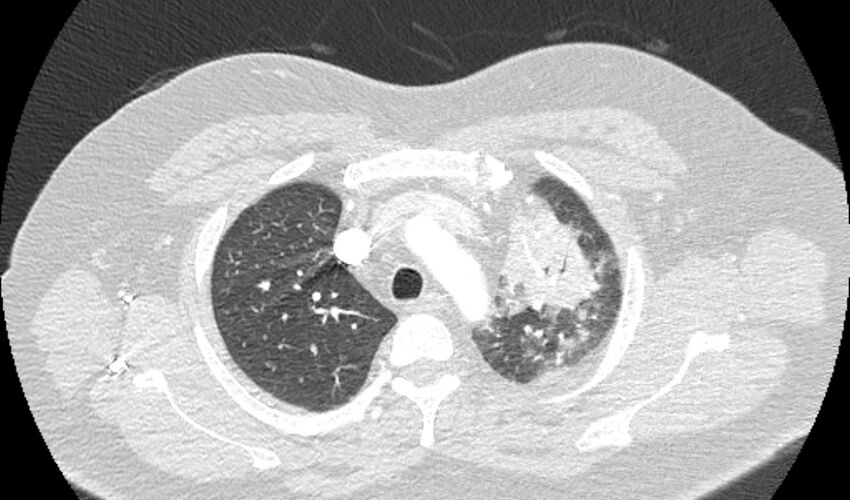 Acute pulmonary embolism with pulmonary infarcts (Radiopaedia 77688-89908 Axial lung window 17).jpg