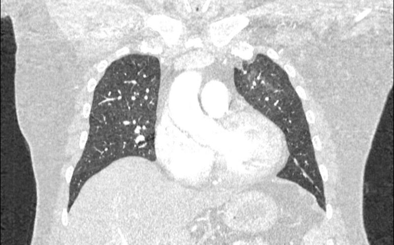 File:Acute pulmonary embolism with pulmonary infarcts (Radiopaedia 77688-89908 Coronal lung window 27).jpg
