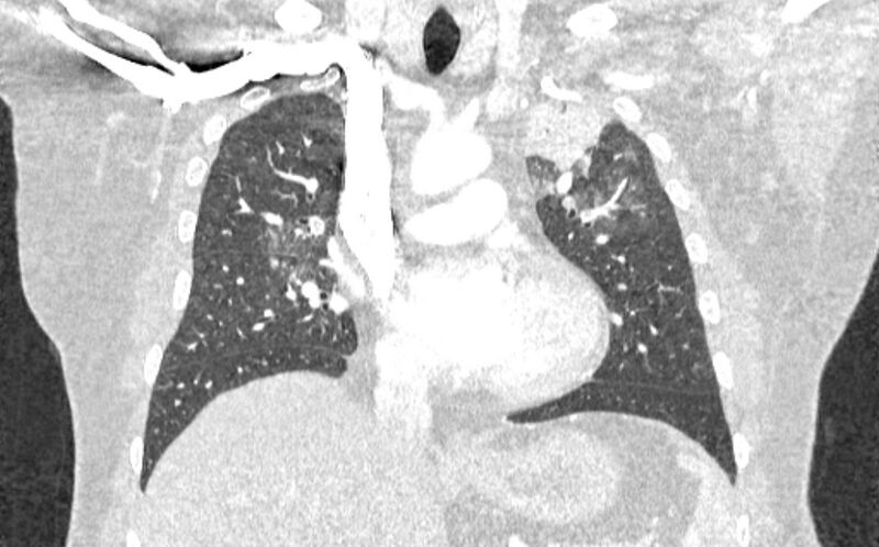 File:Acute pulmonary embolism with pulmonary infarcts (Radiopaedia 77688-89908 Coronal lung window 40).jpg