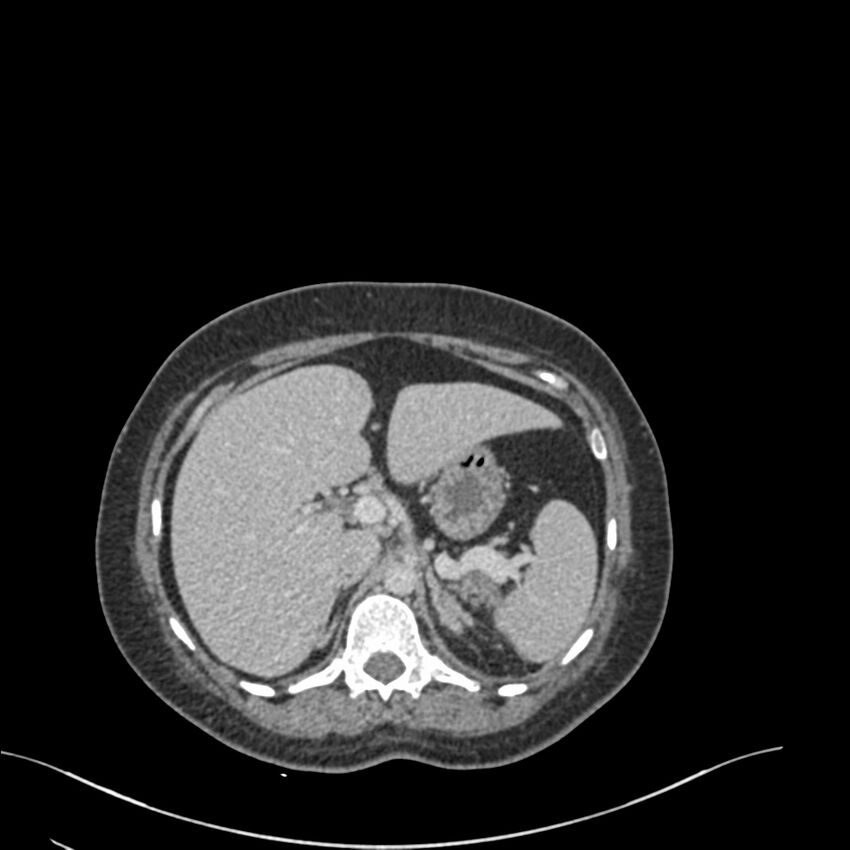 Acute pyelonephritis with renal vein thrombosis (Radiopaedia 58020-65053 Axial renal parenchymal phase 3).jpg