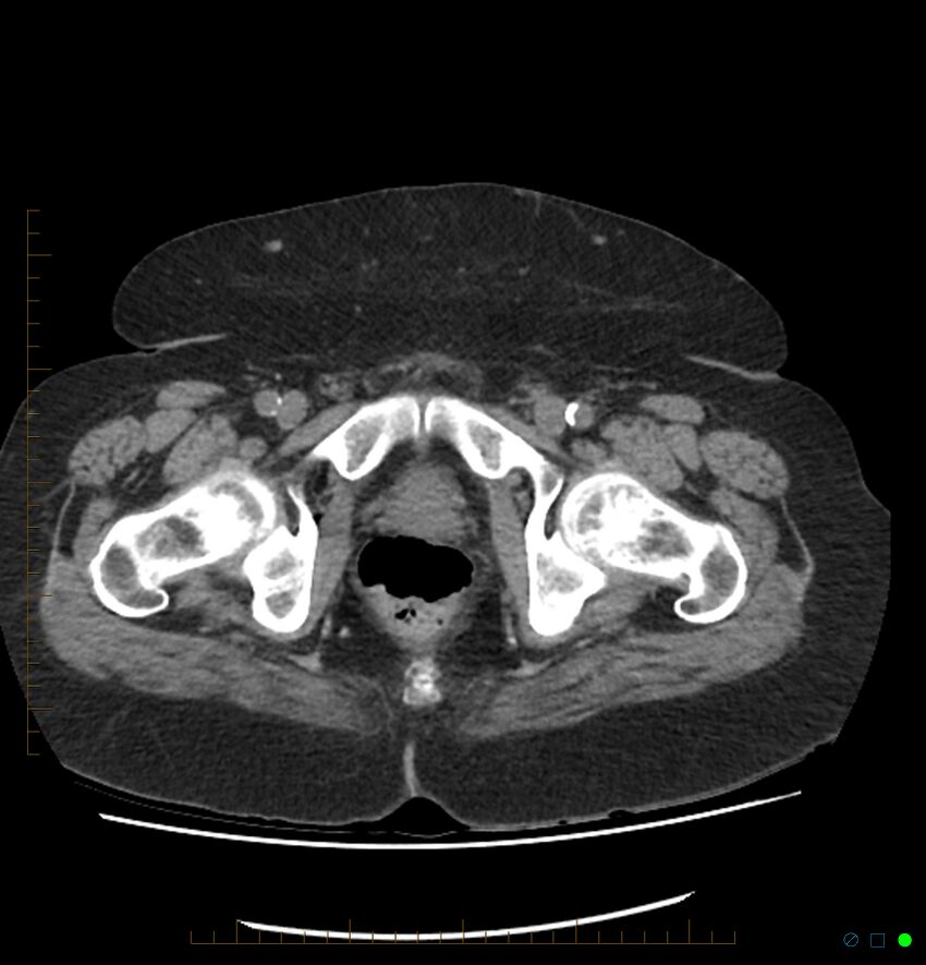 Acute renal failure post IV contrast injection- CT findings (Radiopaedia 47815-52557 Axial non-contrast 80).jpg