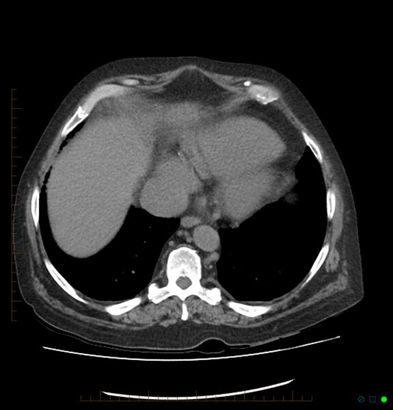 File:Acute renal failure post IV contrast injection- CT findings (Radiopaedia 47815-52557 Axial non-contrast 9).jpg