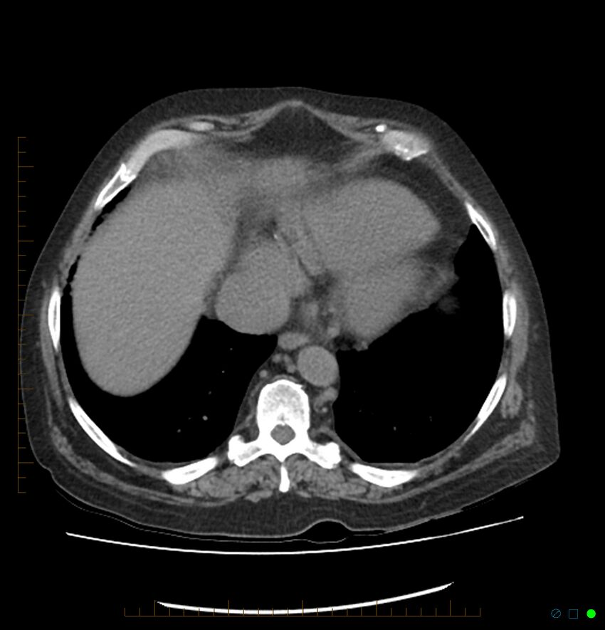 Acute renal failure post IV contrast injection- CT findings (Radiopaedia 47815-52557 Axial non-contrast 9).jpg