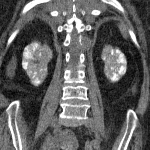 File:Acute tubular necrosis (Radiopaedia 28077-28334 Coronal non-contrast 25).jpg