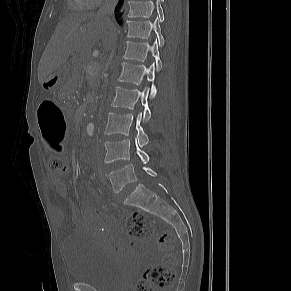 File:Acute vertebral body compression fractures (Radiopaedia 31757-32693 Sagittal bone window 30).jpg