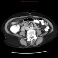 Adenocarcinoma of the colon (Radiopaedia 8191-9039 Axial liver window 44).jpg
